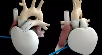 Il cuore artificiale totale è quasi pronto per per i primi trapianti